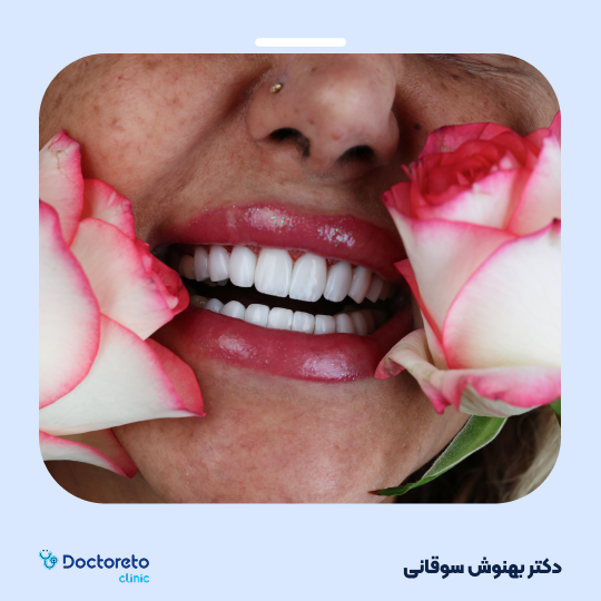 لمینت دندان با برند آی پی اس ایمکس (هر واحد)