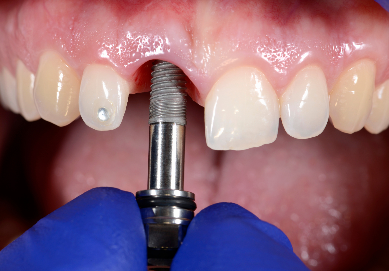 ایمپلنت دندان بدون روکش (هر واحد)