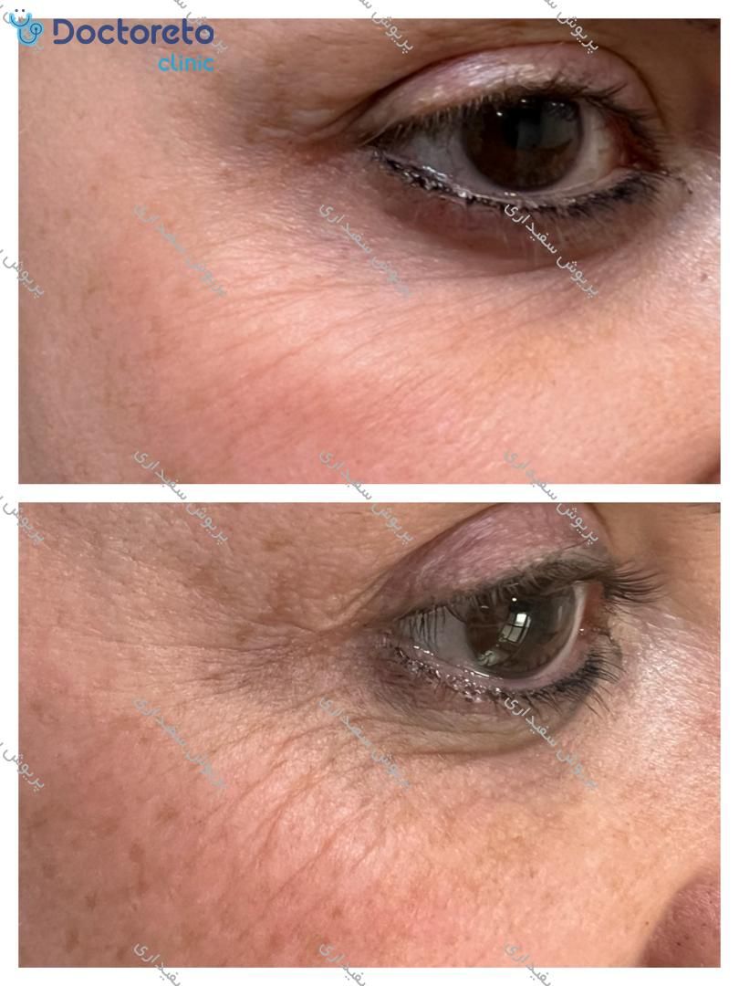 تزریق بوتاکس صورت (پیشانی، خط اخم، پنجه کلاغی)💉