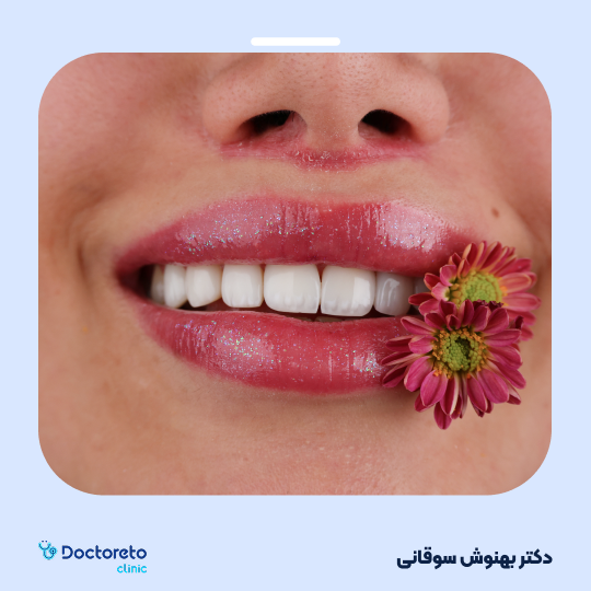 کامپوزیت تکه ای(اصلاح و طراحی لبخند) (هرواحد)