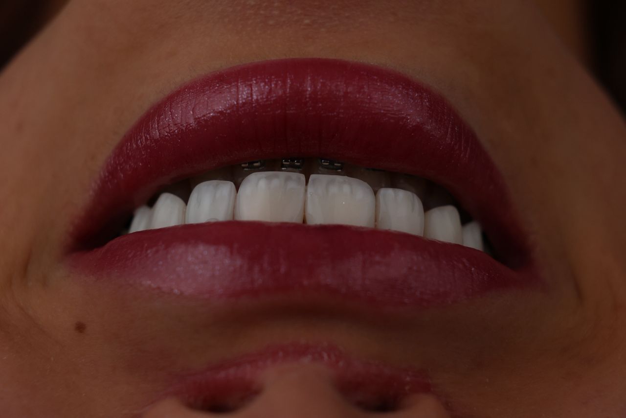 کامپوزیت تکه ای(اصلاح و طراحی لبخند) (هرواحد)