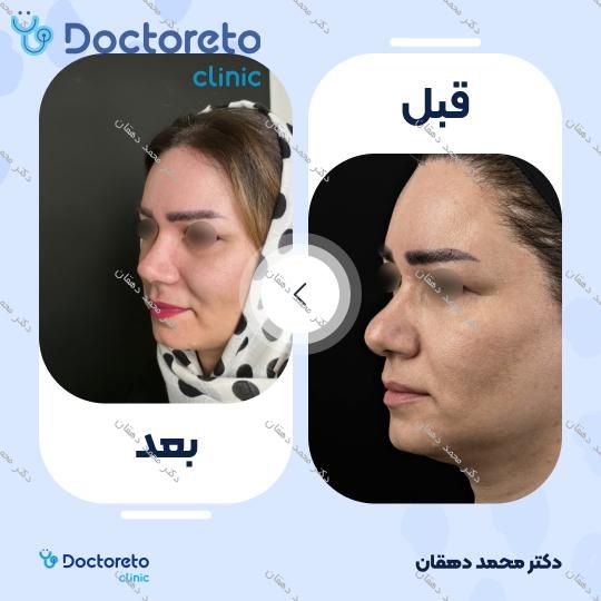 عمل جراحی بینی (رینوپلاستی)