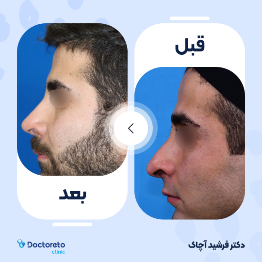 عمل جراحی ترمیمی زیبایی بینی (رینوپلاستی)