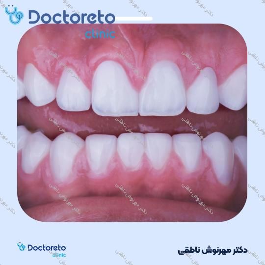 لمینت دندان (هر واحد)