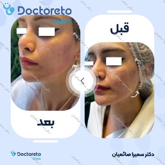 تزریق ژل زاویه فک