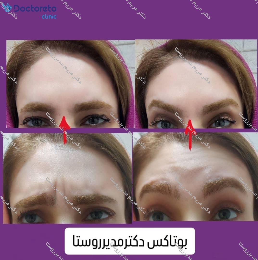 تزریق بوتاکس صورت (پیشانی، خط اخم، پنجه کلاغی)💉