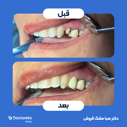 روکش دندان PFM (هر واحد)