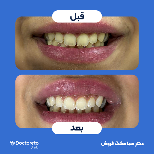 آفیس بلیچینگ (سفید کردن دندان) دو فک با مواد آمریکایی