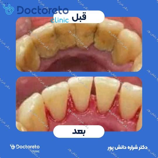 جرم گیری کامل دندان‌های دو فک با بروساژ
