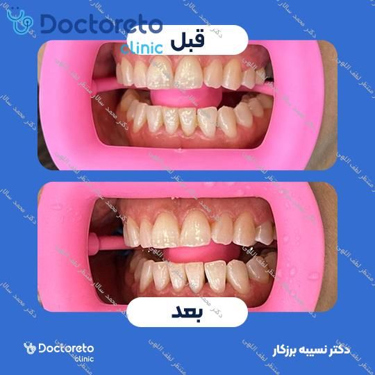 جرم گیری کامل دندان‌های دو فک با بروساژ