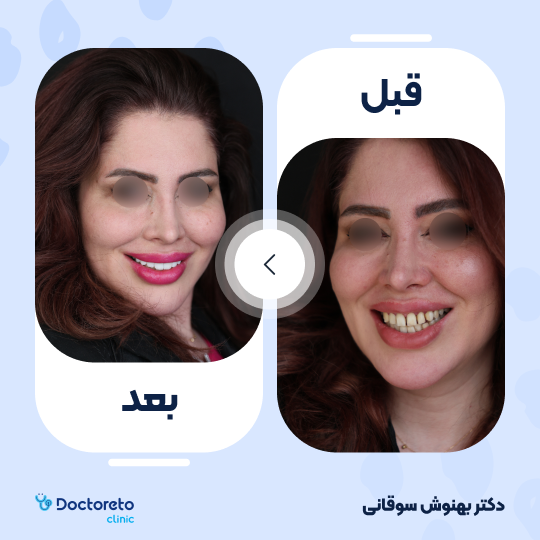 ونیر کامپوزیت (هر واحد)