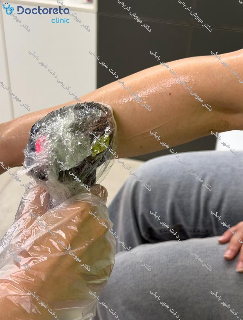 لیزر موهای زائد بانوان و آقایان با دستگاه سوپرانو آیس تیتانیوم