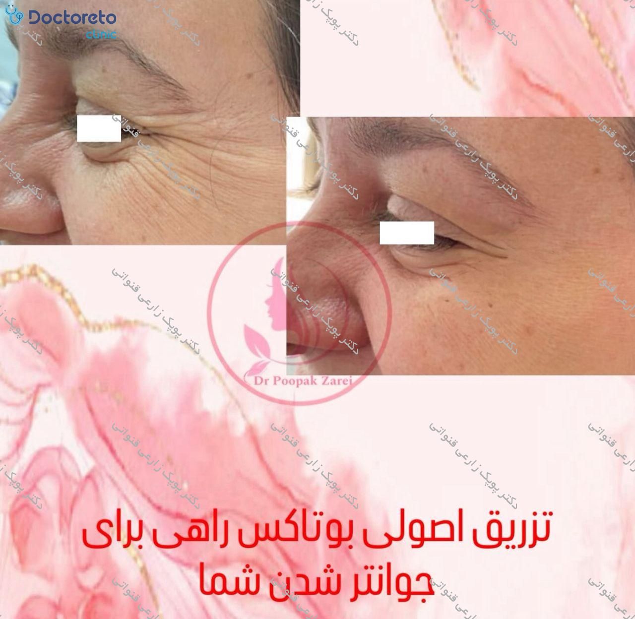 تزریق بوتاکس صورت (پیشانی، خط اخم، پنجه کلاغی)💉