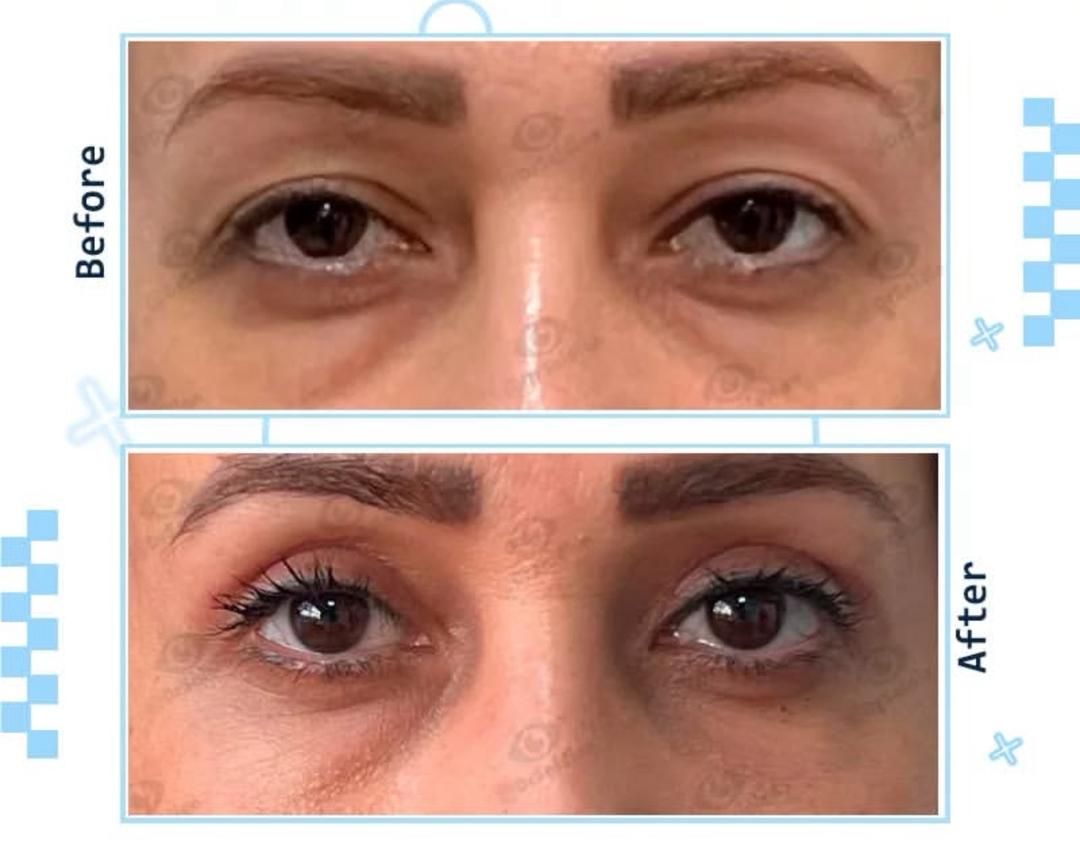 جراحی بلفاروپلاستی پلک بالا