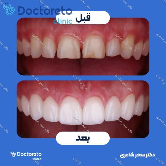 ونیر کامپوزیت (هر واحد)