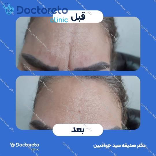 تزریق بوتاکس صورت (پیشانی، خط اخم، پنجه کلاغی)💉