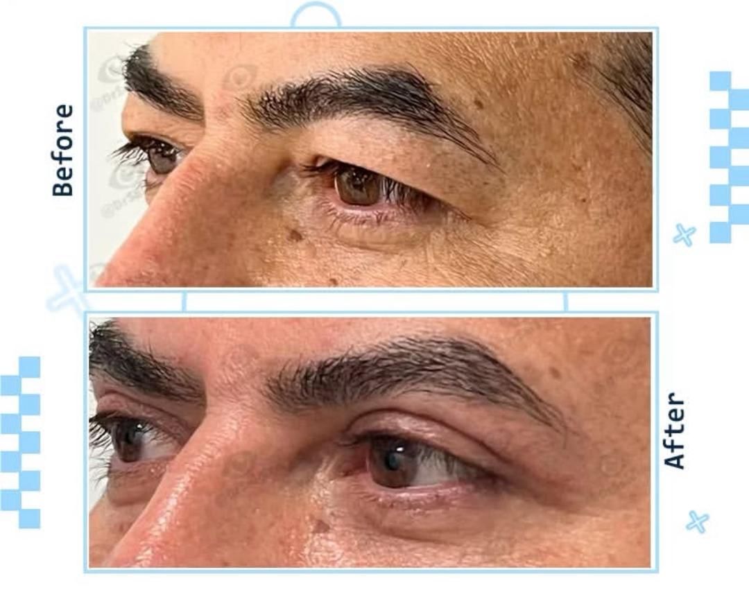 جراحی بلفاروپلاستی پلک بالا