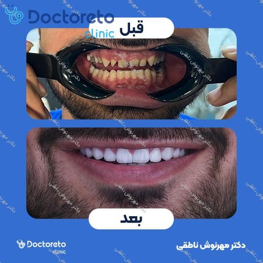 لمینت دندان (هر واحد)