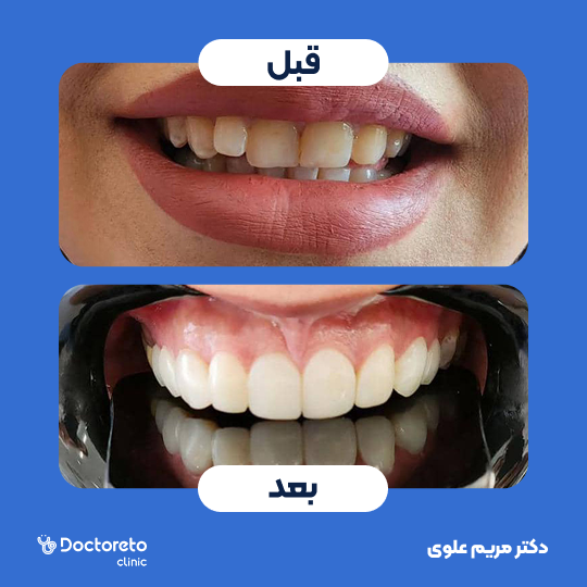 جرم گیری کامل دندان‌های دو فک با بروساژ