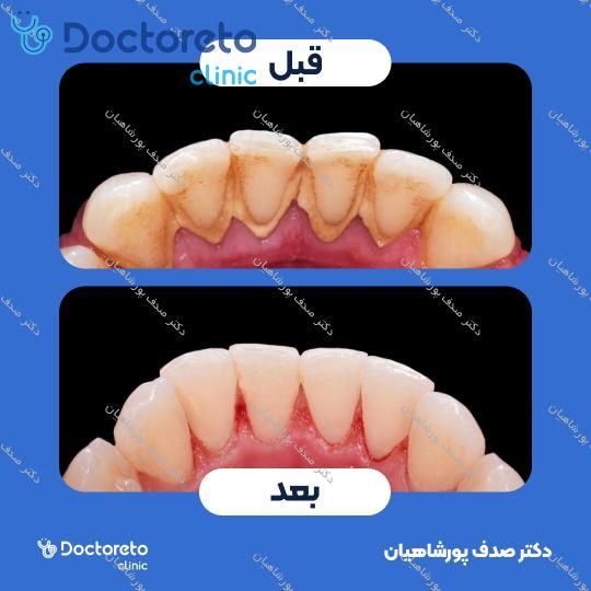 جرم گیری کامل دندان‌های دو فک با بروساژ