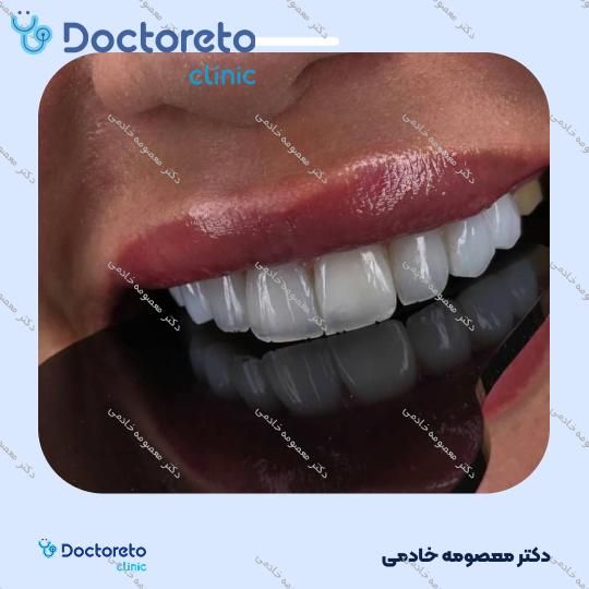 لمینت دندان (هر واحد)