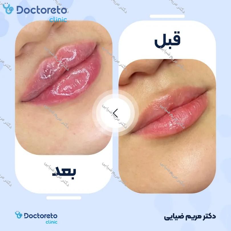 تزریق ژل لب