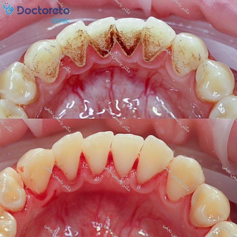 جرم گیری کامل دندان‌های دو فک با بروساژ🦷