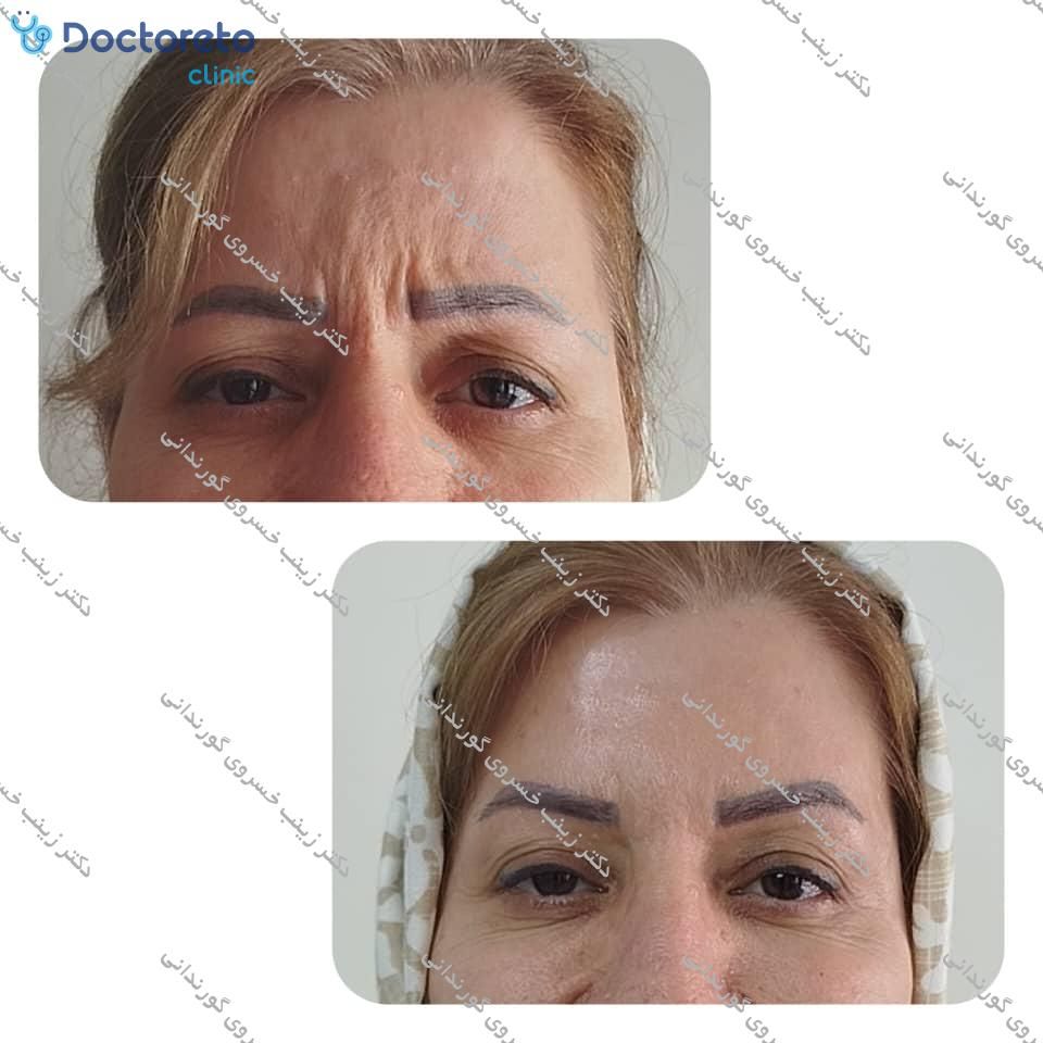 تزریق بوتاکس صورت (پیشانی، خط اخم، پنجه کلاغی)💉