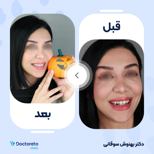 کامپوزیت تکه ای(اصلاح و طراحی لبخند) (هرواحد)