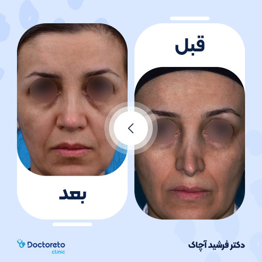 عمل جراحی ترمیمی زیبایی بینی (رینوپلاستی)