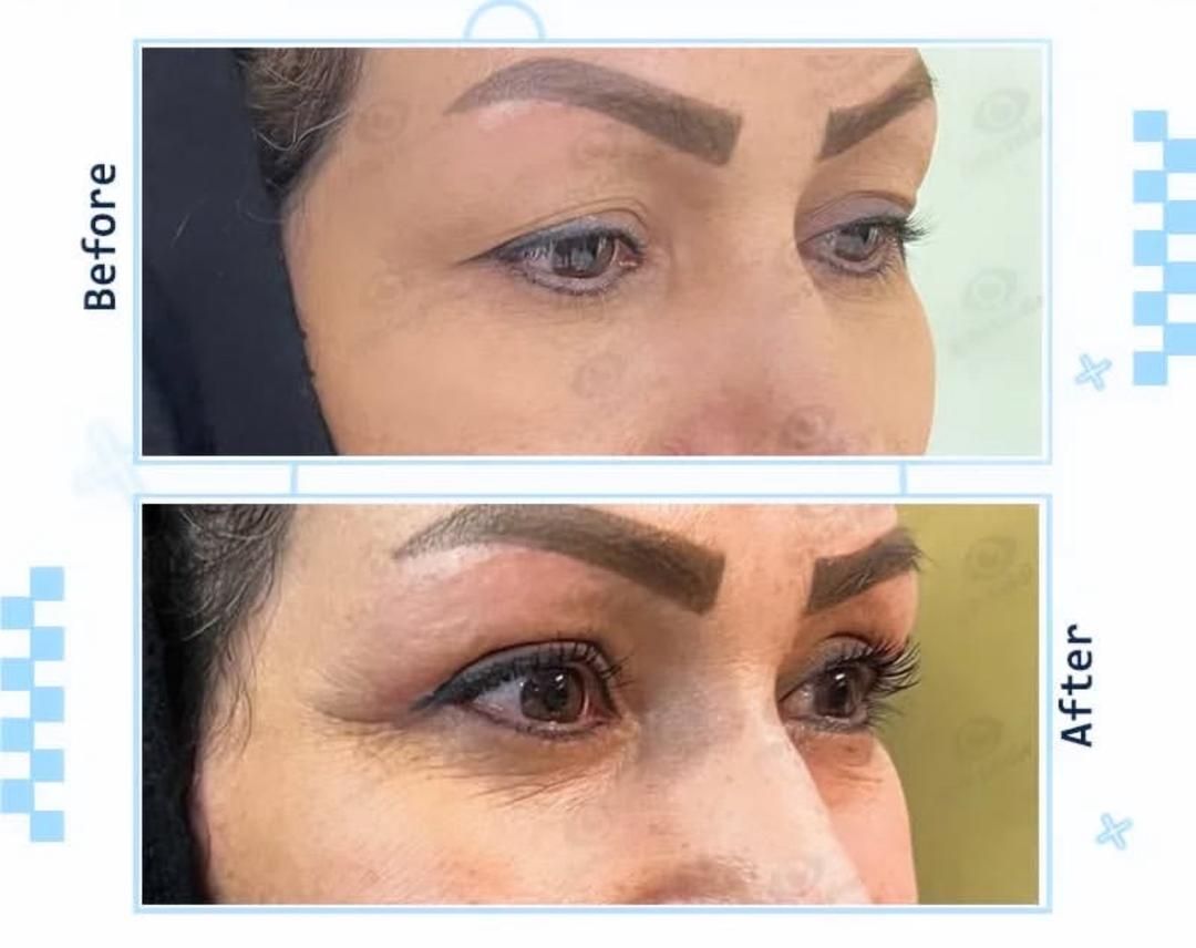 جراحی بلفاروپلاستی پلک بالا