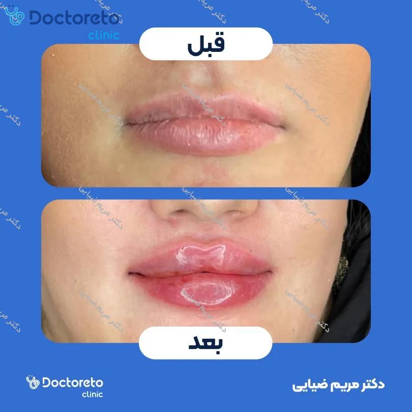 تزریق ژل لب