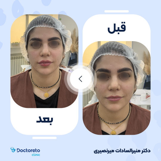 تزریق ژل چانه