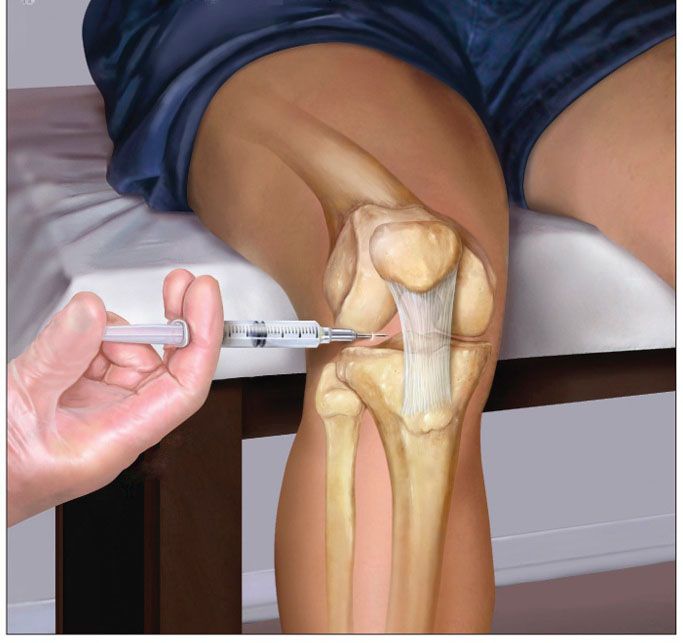 تزریق ژل داخل مفصلی زانو