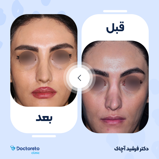 عمل جراحی ترمیمی زیبایی بینی (رینوپلاستی)