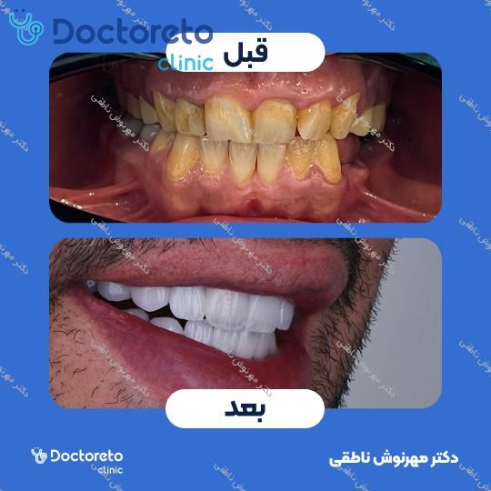 لمینت دندان (هر واحد)