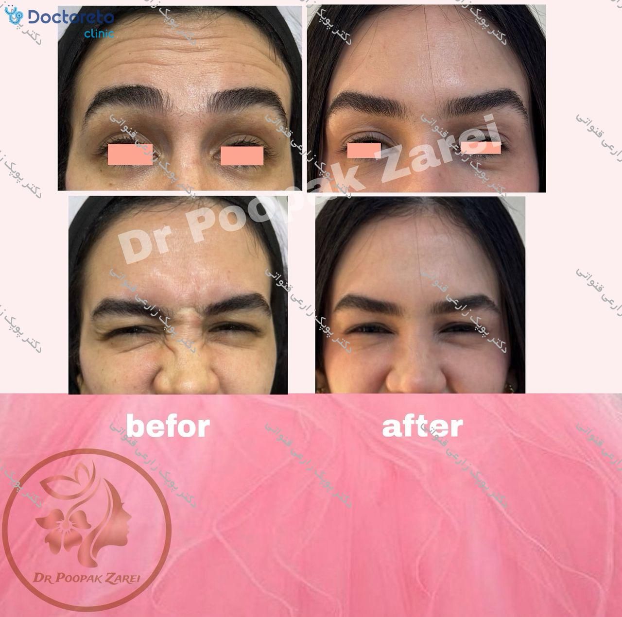 تزریق بوتاکس صورت (پیشانی، خط اخم، پنجه کلاغی)💉