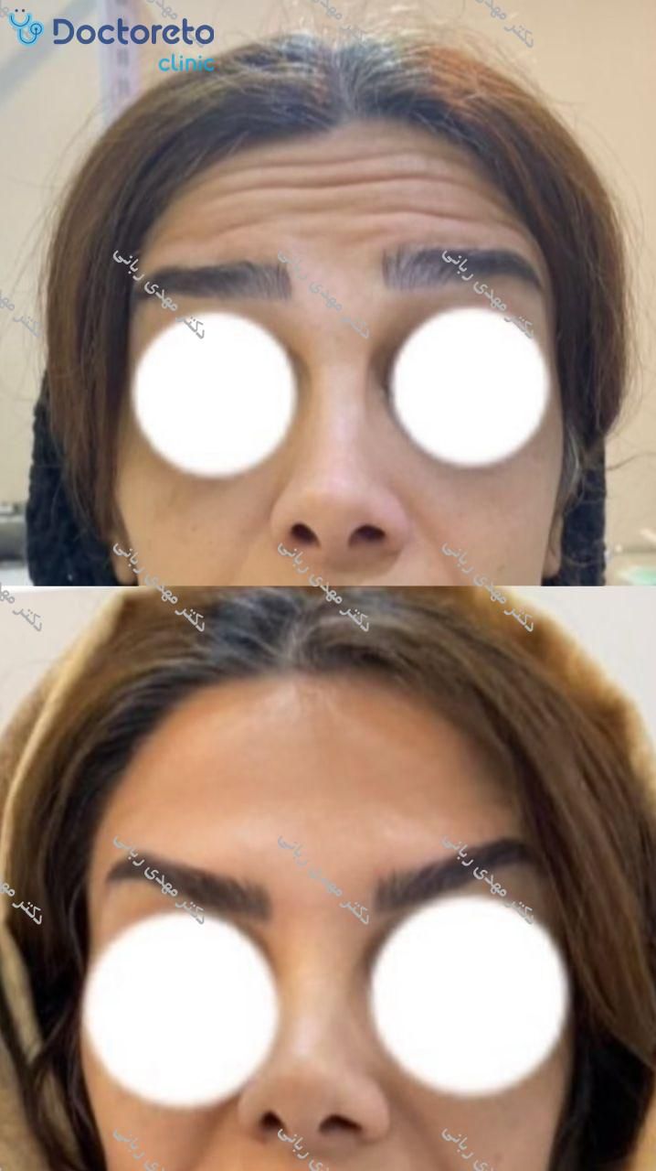 تزریق بوتاکس صورت (پیشانی، خط اخم، پنجه کلاغی)💉