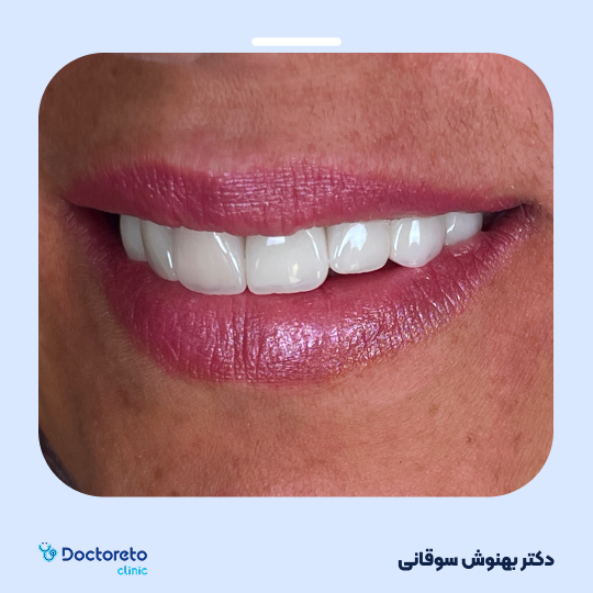 جرم گیری دندان با بروساژ