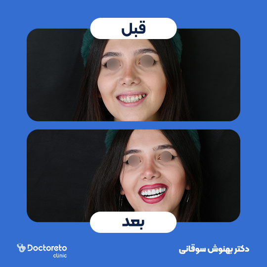 ونیر کامپوزیت (هر واحد)