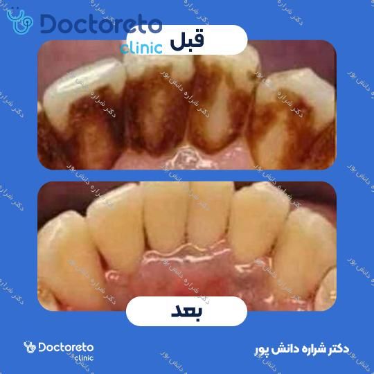 جرم گیری کامل دندان‌های دو فک با بروساژ