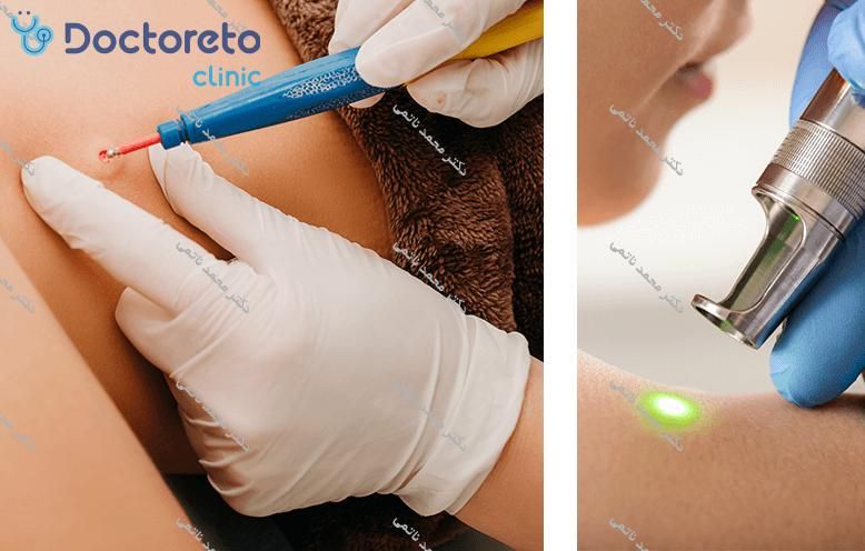 درمان زگیل تناسلی آقایان به روش لیزر CO2