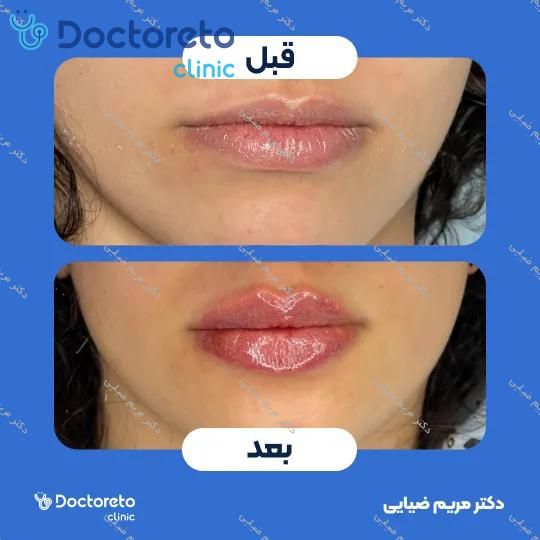 تزریق ژل لب