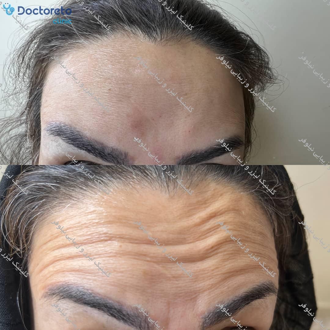 تزریق بوتاکس صورت (پیشانی، خط اخم، پنجه کلاغی)💉