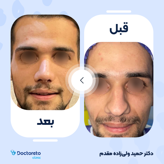 عمل زیبایی بینی گوشتی(رینوپلاستی)