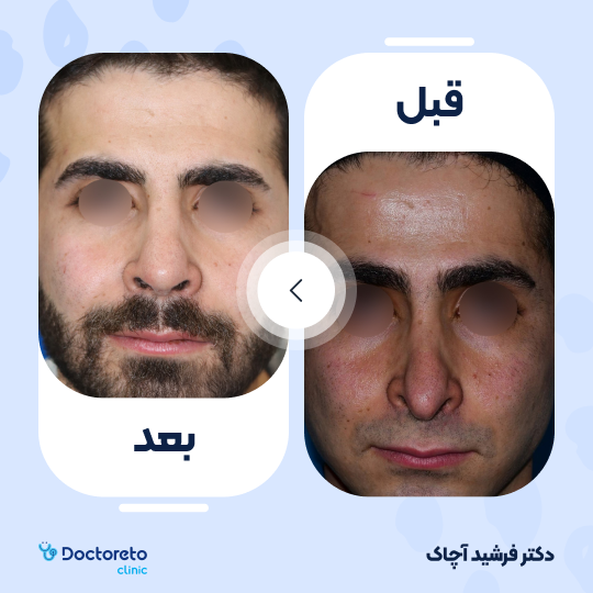 عمل جراحی ترمیمی زیبایی بینی (رینوپلاستی)