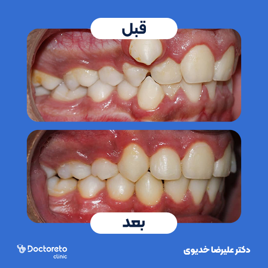 ارتودنسی ثابت فلزی