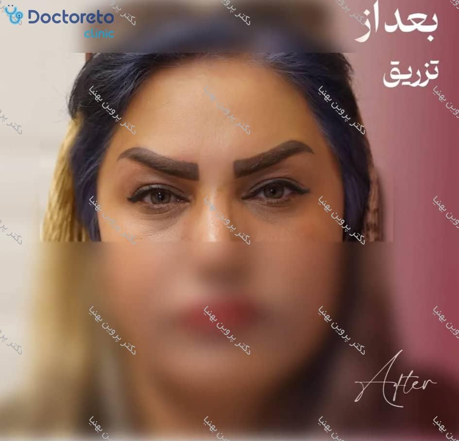 تزریق بوتاکس صورت (پیشانی، خط اخم، پنجه کلاغی)💉