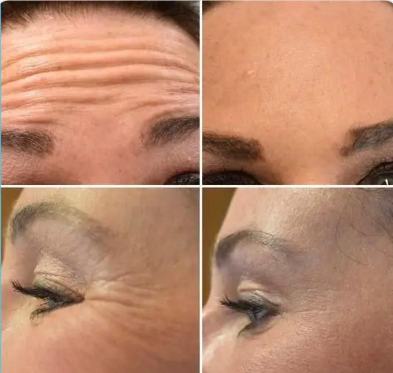 تزریق بوتاکس صورت (پیشانی، خط اخم، پنجه کلاغی)💉