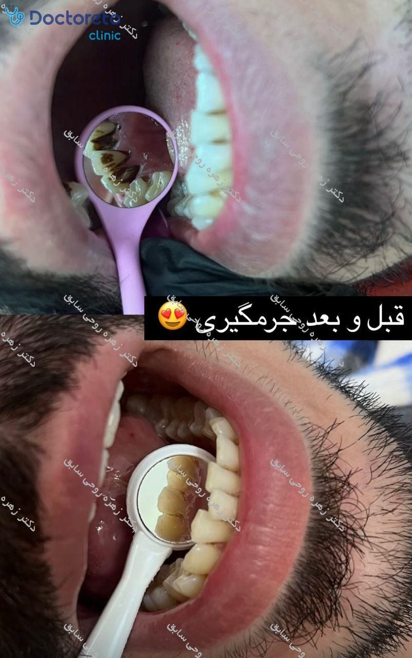جرم گیری کامل دندان‌های دو فک با بروساژ🦷